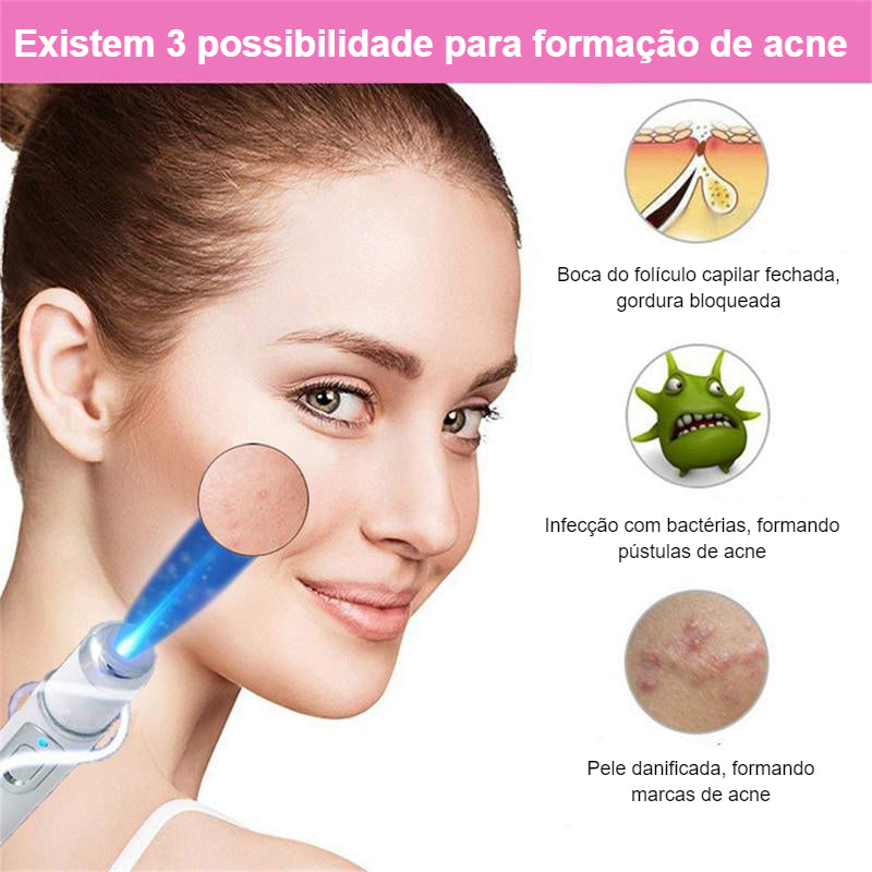 Powerlaser - varizes - acnes